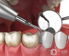 洗牙后牙酸疼怎么辦？