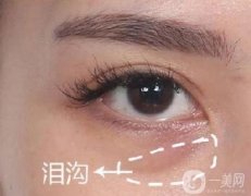 玻尿酸去淚溝是否?哪些人不適合?