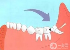 智齒會引起哪些疾病?