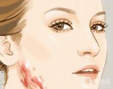 皮膚磨削術(shù)有什么副作用嗎?皮膚磨削術(shù)需要注意什么?