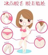 用什么可以全身脫毛?全身脫毛好的方法是什么?