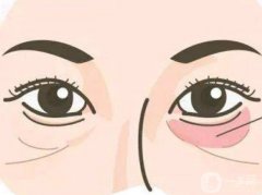 注射玻尿酸填充淚溝多久恢復(fù)自然?