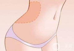 腹部吸脂有嗎？會不會反彈