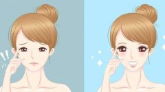 割雙眼皮后多久才能消腫?哪個季節(jié)適合