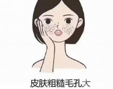 毛孔粗大是什么原因?激光可以改良嗎？