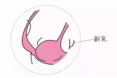 切除副乳后需要多久恢復(fù)?飲食有哪些需要注意？