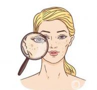 激光可以去除黃褐斑嗎？長(zhǎng)黃褐斑的原因？