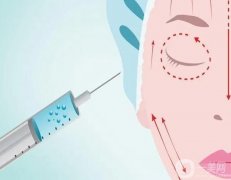 下巴注射玻尿酸需要多少針？