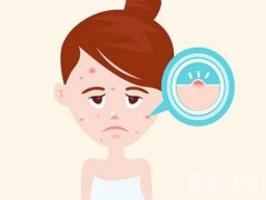 激光祛痘印果怎么樣？