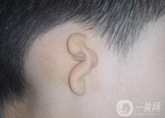 隱耳矯正術(shù)需要多少錢?隱耳矯正術(shù)之后應(yīng)該注意什么?