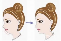 墊下巴有哪些材料