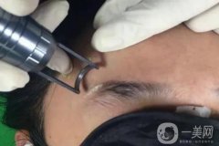 激光洗眉的特點(diǎn)是什么？會(huì)留疤嗎?