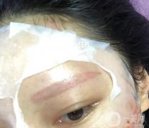 激光洗眉后多久能沾水?激光洗眉有用嗎?