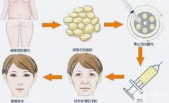 自體脂肪豐臉嗎?自體脂肪豐蘋果肌多少錢?