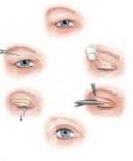 處整形醫(yī)院!處雙眼皮多少錢?