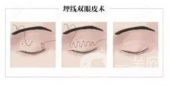 埋線雙眼皮需要注意什么?埋線雙眼皮手術(shù)有什么好處?