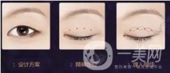 埋線雙眼皮整形醫(yī)院?埋線雙眼皮會有后遺癥嗎?