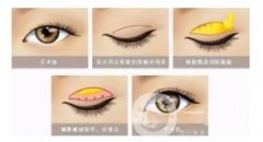 雙眼皮大概多少錢?影響雙眼皮價格的因素有哪些?