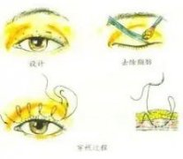 埋線雙眼皮的嗎?埋線雙眼皮手術后應該做什么?