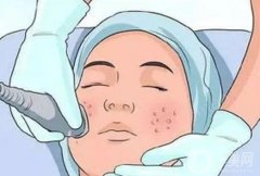 激光收縮毛孔是長(zhǎng)期性的嗎?