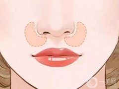 墊鼻基底恢復(fù)自然需要多久?