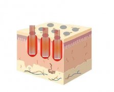 點陣激光恢復好需要多長時間？