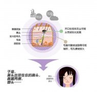 復合彩光嫩膚是什么？風險有哪些？