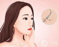 鼻孔縮小手術(shù)的恢復(fù)與消腫需要多長時間？