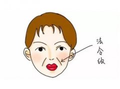 法令紋做熱瑪吉有用嗎?