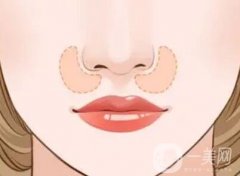 鼻基底在哪里？有必要墊鼻基底嗎