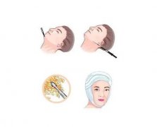 多久面部吸脂要才能看到果?