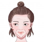 法令紋很深填充鼻基底能改良嗎？