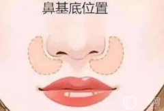墊鼻基底后笑容僵硬嗎?影響面部表情嗎？