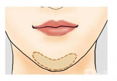 假體墊下巴能維持多久?