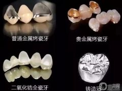 烤瓷牙怎么保養(yǎng)？
