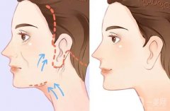 拉皮除皺的果能維持多久？