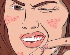 激光去痘印后有什么反應(yīng)?