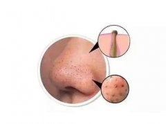 酒渣鼻可以做嗎?適合的人群有哪些?