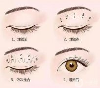 埋線雙眼皮手術(shù)前后有哪些注意事項?