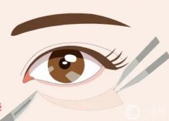 祛眼袋手術(shù)恢復(fù)好需要幾天?有哪些去除眼袋的手術(shù)方法?