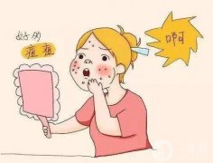 祛痘痘可以使用果酸換膚嗎?