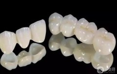 烤瓷牙會變黃嗎？烤瓷牙有哪些禁忌