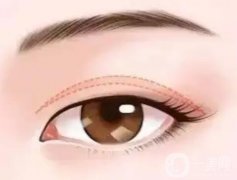 定點雙眼皮有什么優(yōu)點和缺點？