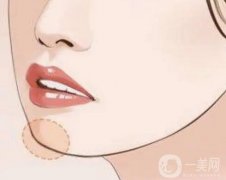 墊下巴之后多久可以吃飯，多久消腫？