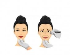 電波拉皮會(huì)更快衰老嗎?電波拉皮有什么作用？