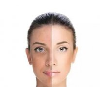 果酸換膚有什么副作用?