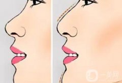 隆鼻后的禁忌有哪些？