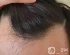 發(fā)際線(xiàn)整形有哪些危害？