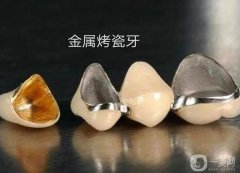 烤瓷牙與牙套、牙冠的區(qū)別是什么