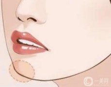墊下巴手術(shù)后多長(zhǎng)時(shí)間可以消腫？